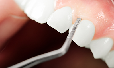 Für ein gesundes Zahnfleisch – Parodontitis richtig vorbeugen